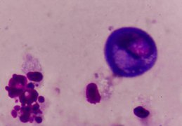 abnormal pap smear