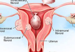 Uterine Fibroids