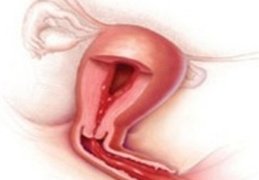 vaginal bleeding