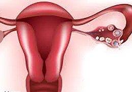 ovarian cysts removal