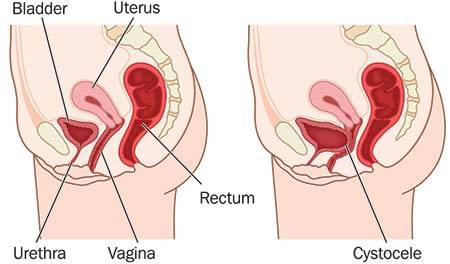 anterior vaginal repair and recovery time Toe itching on bottom
