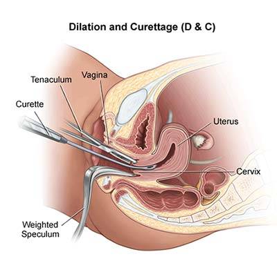 https://www.obgynecologistnyc.com/wp-content/uploads/2016/09/Dilation-Curettage-DC.jpg