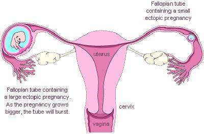 Ectopic Pregnancy Is Rare. Here's What You Need To Know.