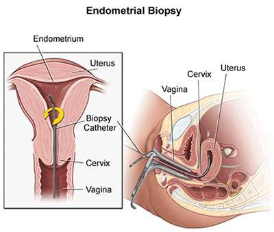 Endometrial Biopsy NYC  Endometrium Specialist in New York