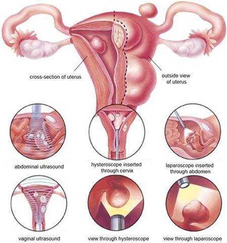 Hysteroscopic Myomectomy / Polypectomy