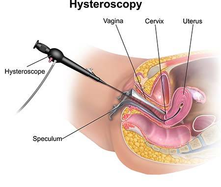 Hysteroscopy