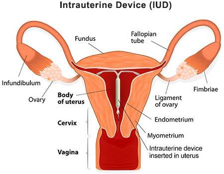 Intrauterine Device (IUD)