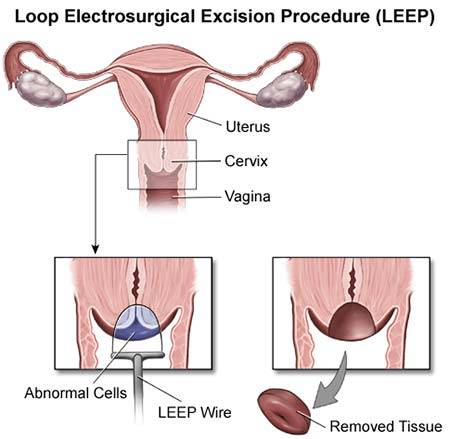 hpv treatment leep electrosurgical excision procedure papiloma krema proizvodjac