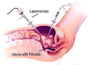 laparoscopic hysterectomy