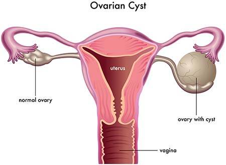 Ovarian Cysts · Cysts Removal Specialist in NYC