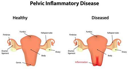 Pelvic Inflammatory disease (PID)