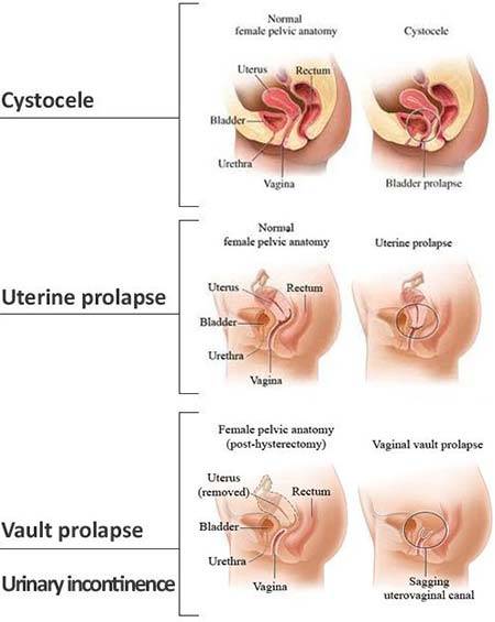 Pelvic Prolapse Treatment Pelvic Floor Specialist Doctor Dr