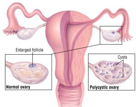 Polycystic Ovarian Syndrome