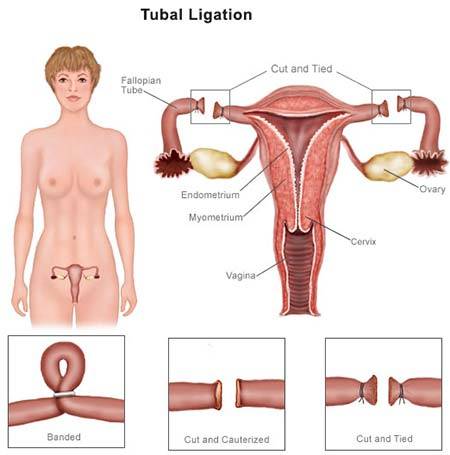 tubal ligation sterilization specialist