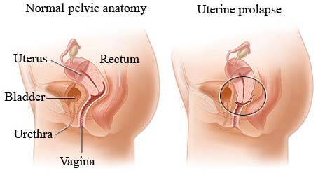 Uterine Prolapse Treatment Pelvic Floor Specialist Doctor Dr