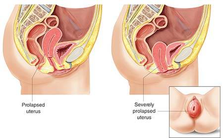 Confirm. cervix coming out of vagina suggest Cervix coming out of vagina