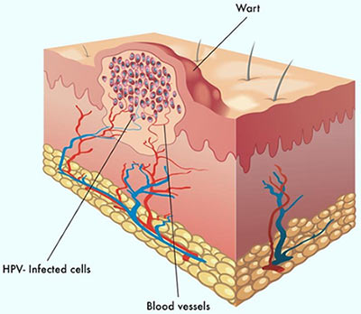 Treatment Anal Warts