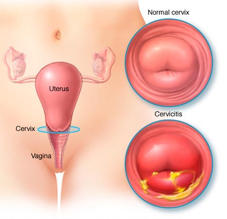 Cervicitis | Cervix Pain | NYC Pelvic Doctors