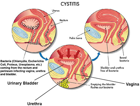 main causes of cystitis