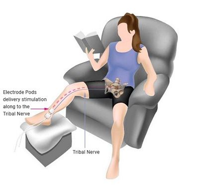 Posterior tibial nerve stimulation (PTNS)