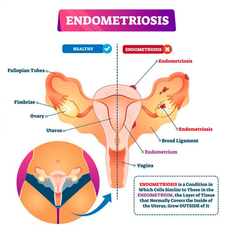 Normal Menstrual Cramps or Endometriosis: How to Tell the Difference:  OB-GYN Associates of Marietta: Obstetrics and Gynecologist