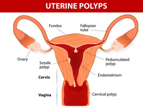 uterine polyps